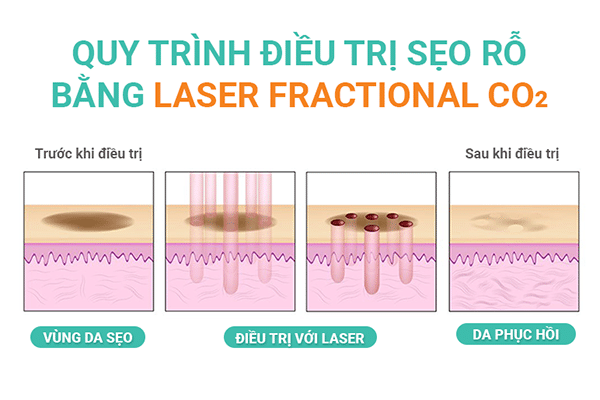 Quy trình điều trị sẹo rỗ bằng phương pháp Laser Fractional CO2